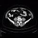 Crohn's disease, ileocecal resection, stenosis of anastomosis: CT - Computed tomography